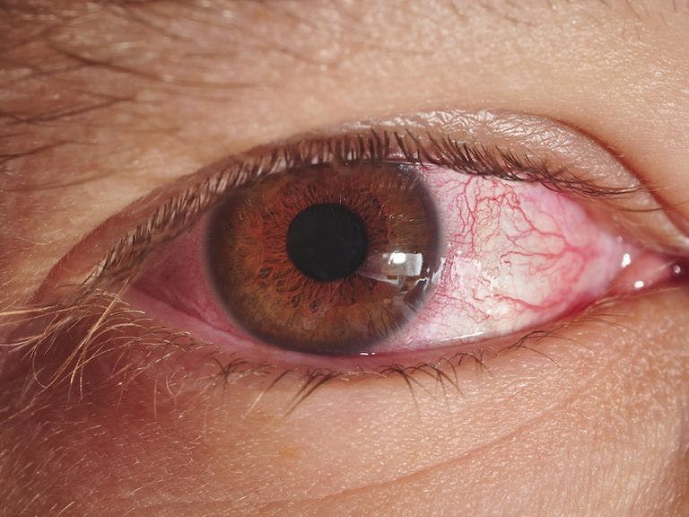Why Does Cannabis Make Your Eyes Red?