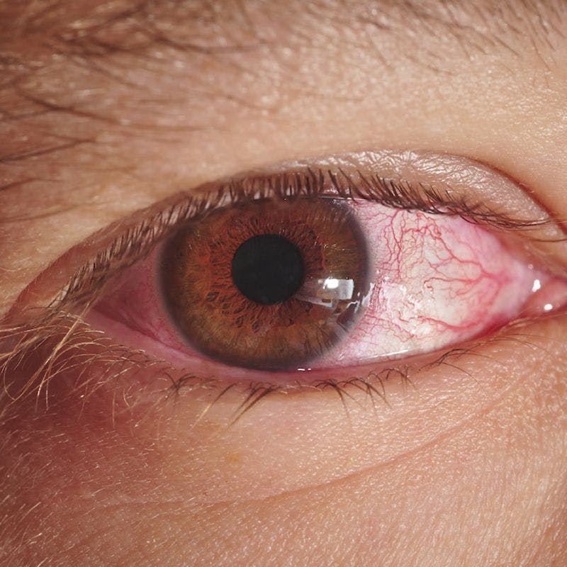 Why Does Cannabis Make Your Eyes Red?